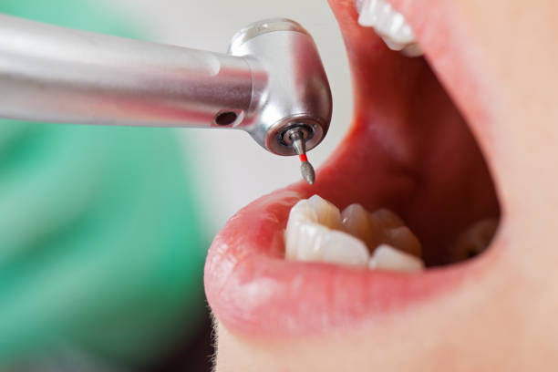 Best Emergency Treatment for Dental Infections or Abscesses in Cabool, MO